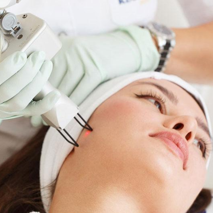 Лазерное удаление постакне