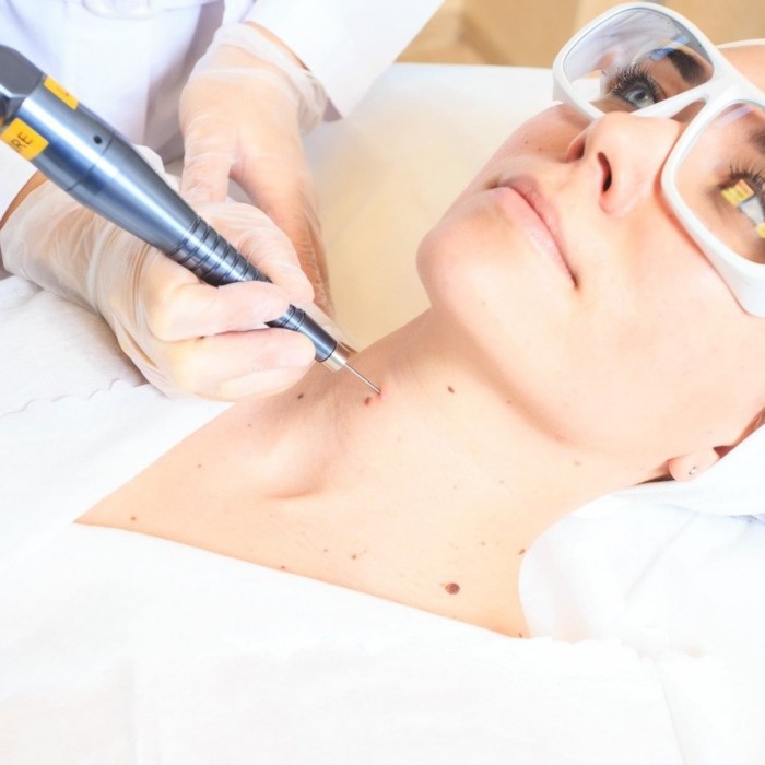 Лазерное удаление кератом