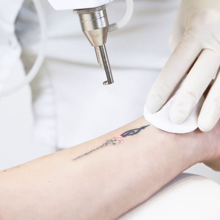 Лазерное удаление татуировок